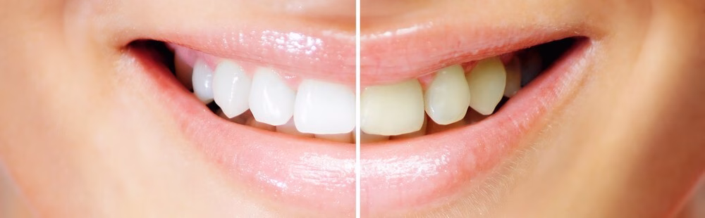 Branqueamento Dentário – Saiba Como Branquear os Dentes Sem Complicações