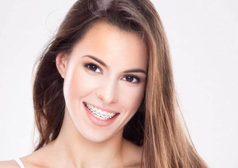 Tenho que usar Aparelho Dentário, e agora?