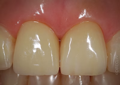 Caso Clínico — Implante dentário unitário
