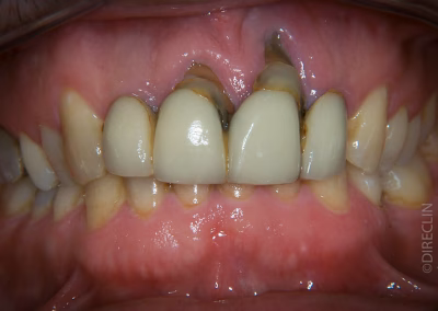 Caso Clínico — Implantes Dentários